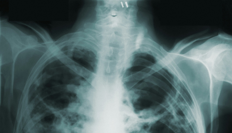 La tuberculosis vuelve a golpear a la Argentina