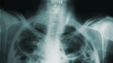 La tuberculosis vuelve a golpear a la Argentina