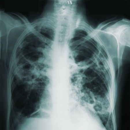 La tuberculosis vuelve a golpear a la Argentina